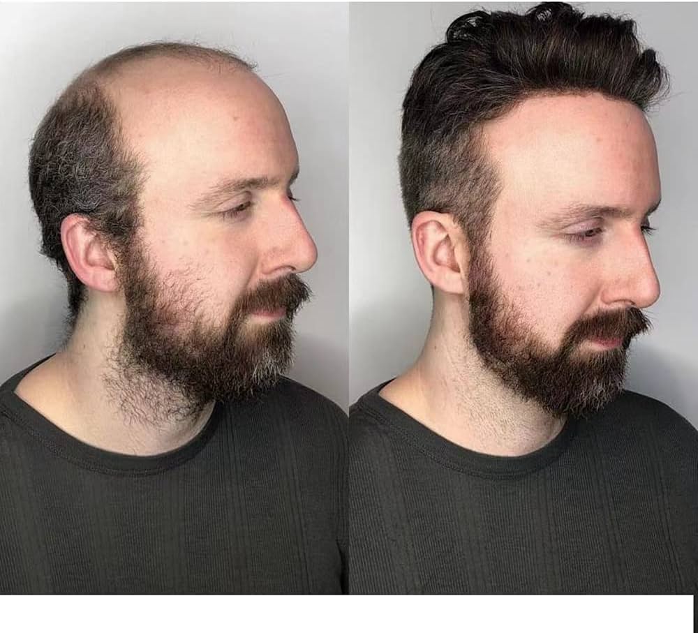 Non Surgical Hair Transplant Hyderabad