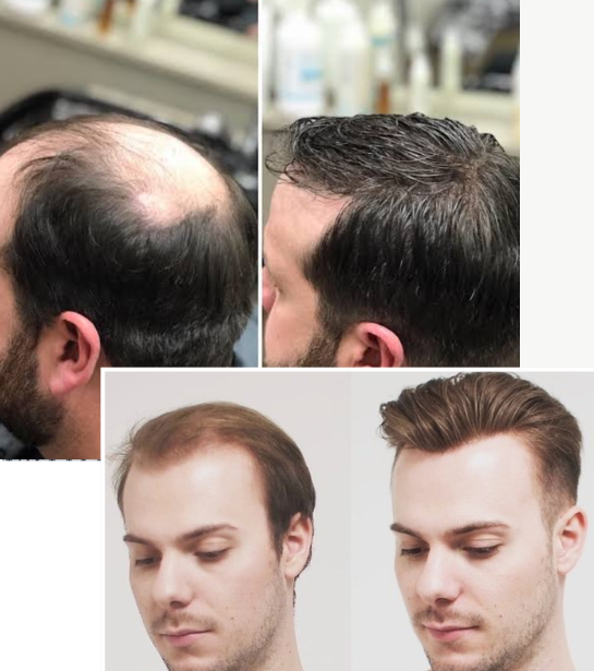 Best Non-Surgical Hair Replacement & Extensions Studio in Hyderabad