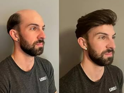 Hair Bonding - Get Your Hair Back Instantly  Free Hair Bonding Consultation at Use Famous Hair Studio!