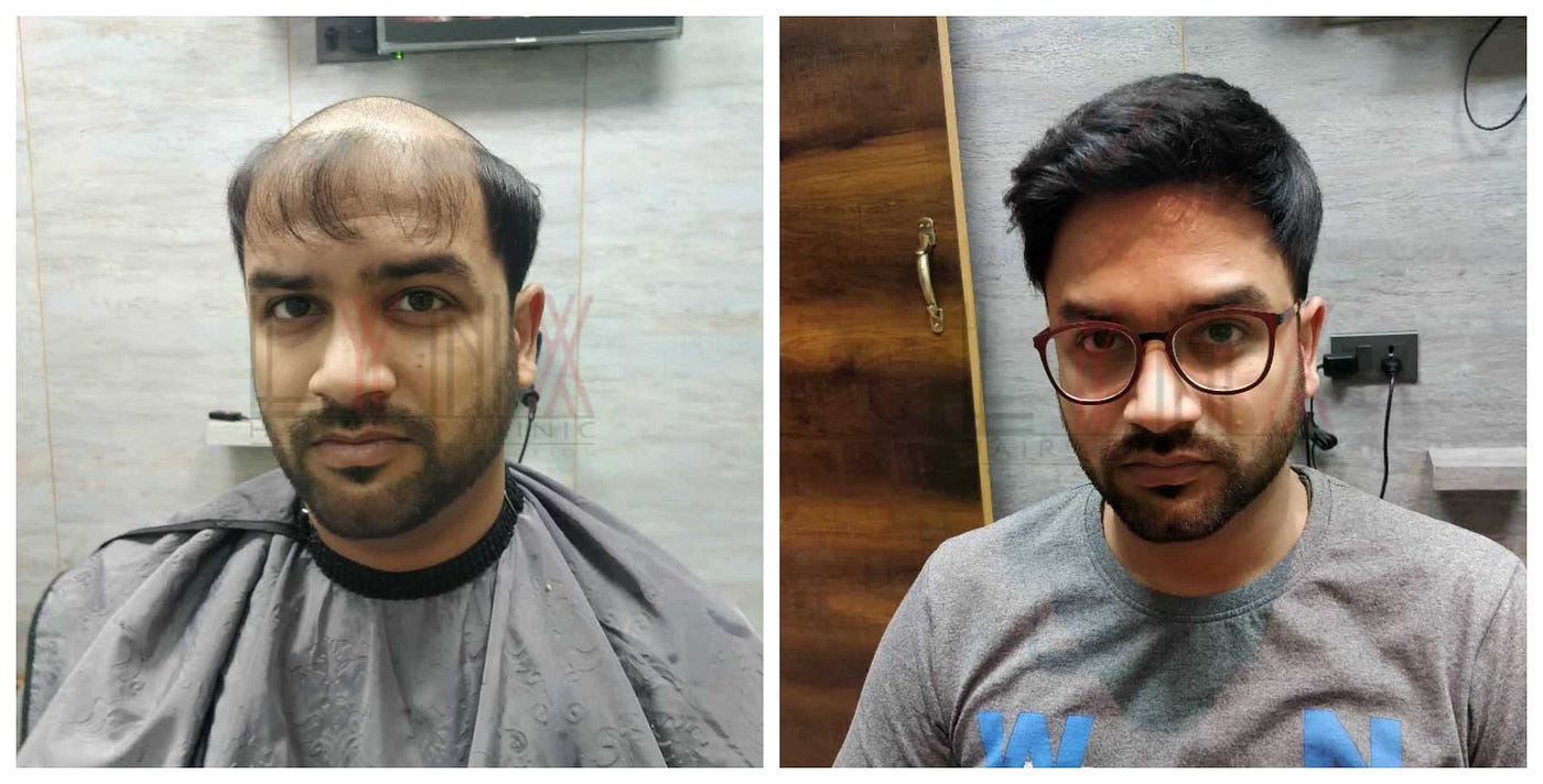 Clip In Hair Patch System — Instant Style Upgrade in Hyderabad