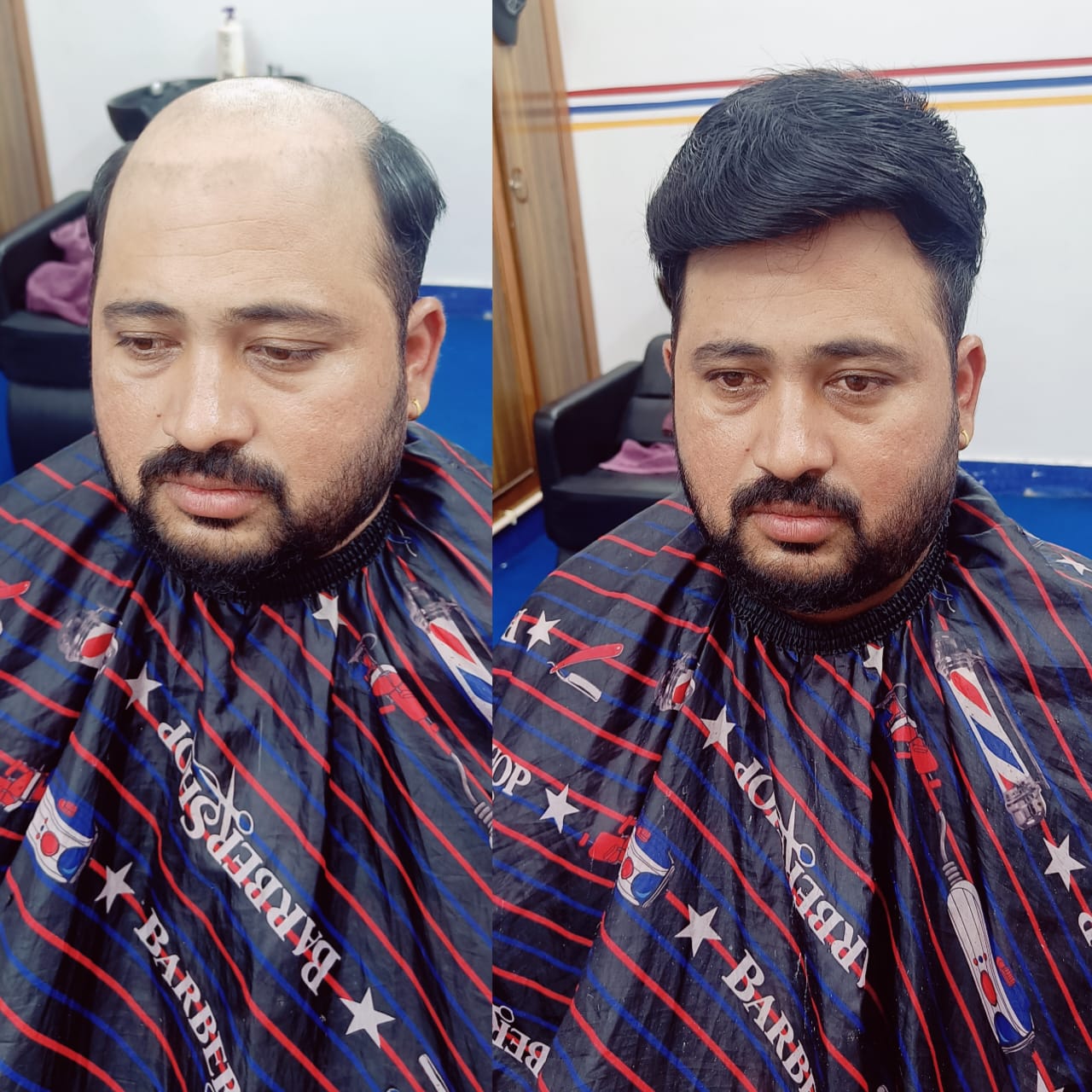 hair patch service in Hyderabad best hair service best fixing with natural hair patch