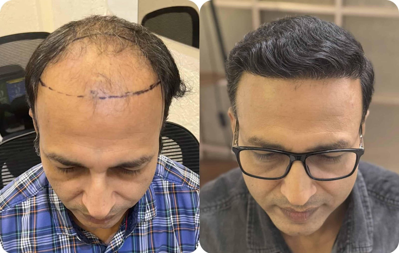 Men's Natural Hairline Transformation at Famous Hair Studio Banjara hills Hyd  2